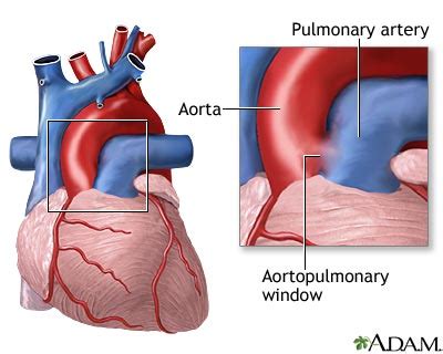 ap window heart disease.